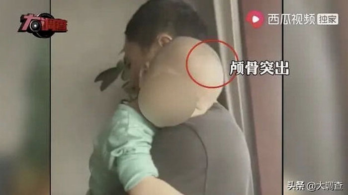 一位患儿饮用假奶粉后,颅骨突出,头部变大,俗称“大头娃娃”。(视频截图.jpg 一位患儿饮用假奶粉后,颅骨突出,头部变大,俗称“大头娃娃”。(视频截图.jpg