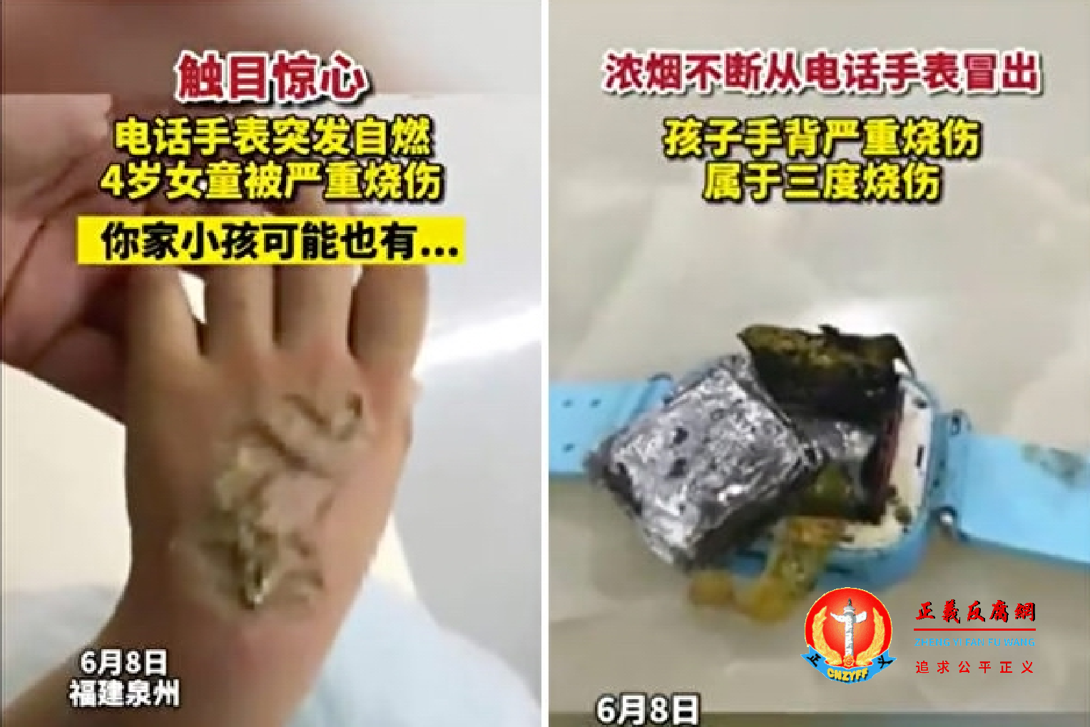 福建泉州4岁女童依依(化名)所佩戴的电话手表突然发生爆炸,孩子的手背皮肤被严重烧伤。.png 福建泉州4岁女童依依(化名)所佩戴的电话手表突然发生爆炸,孩子的手背皮肤被严重烧伤。.png