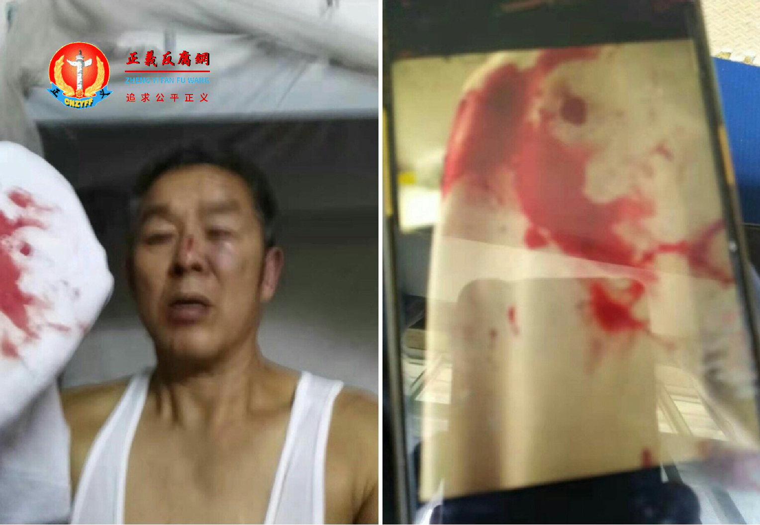 徐金平被殴打血流满面,肋骨骨折。.png 徐金平被殴打血流满面,肋骨骨折。.png