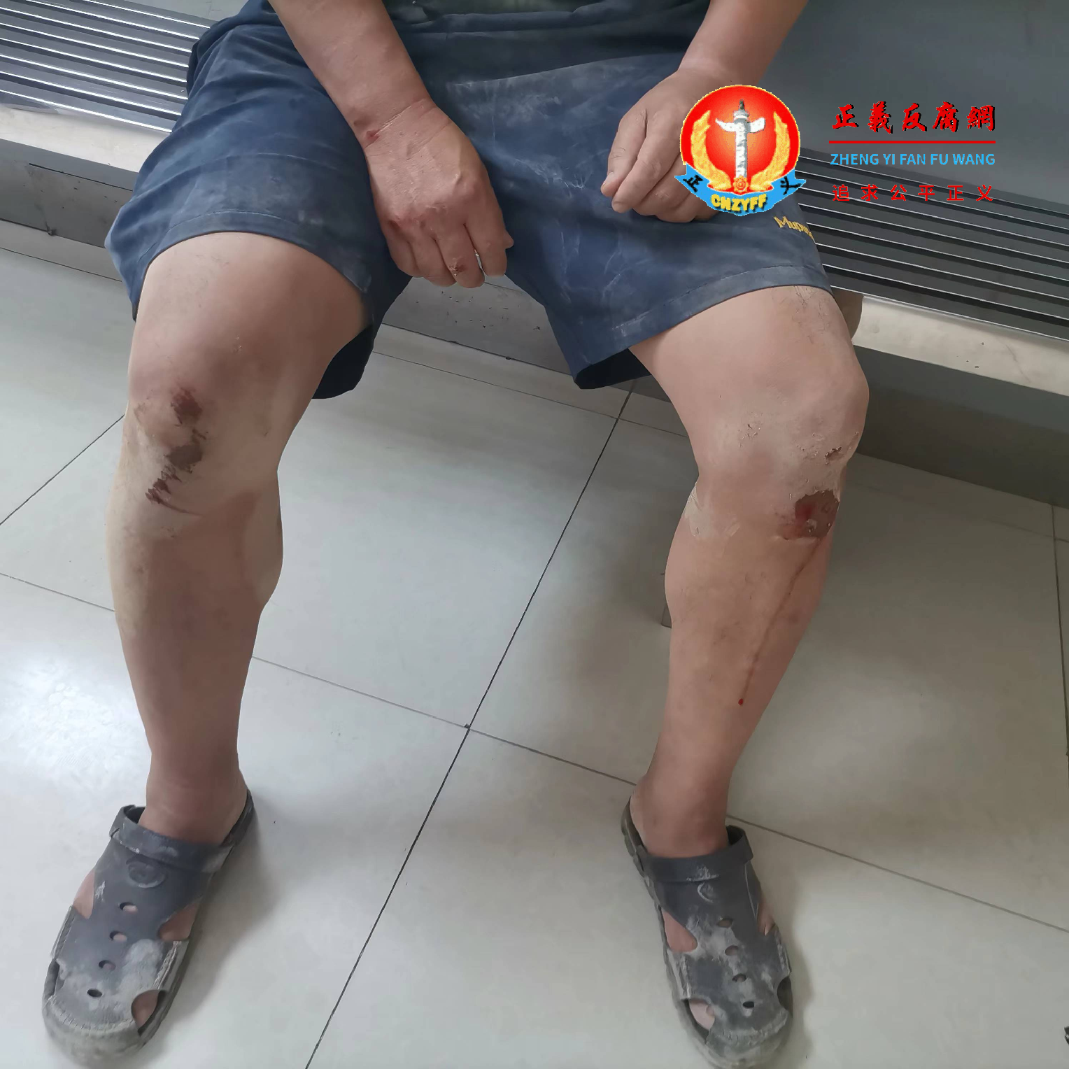 广西南宁市高新区政府派“匪警”镇压,市民被“匪警”殴打的伤。.png 广西南宁市高新区政府派“匪警”镇压,市民被“匪警”殴打的伤。.png