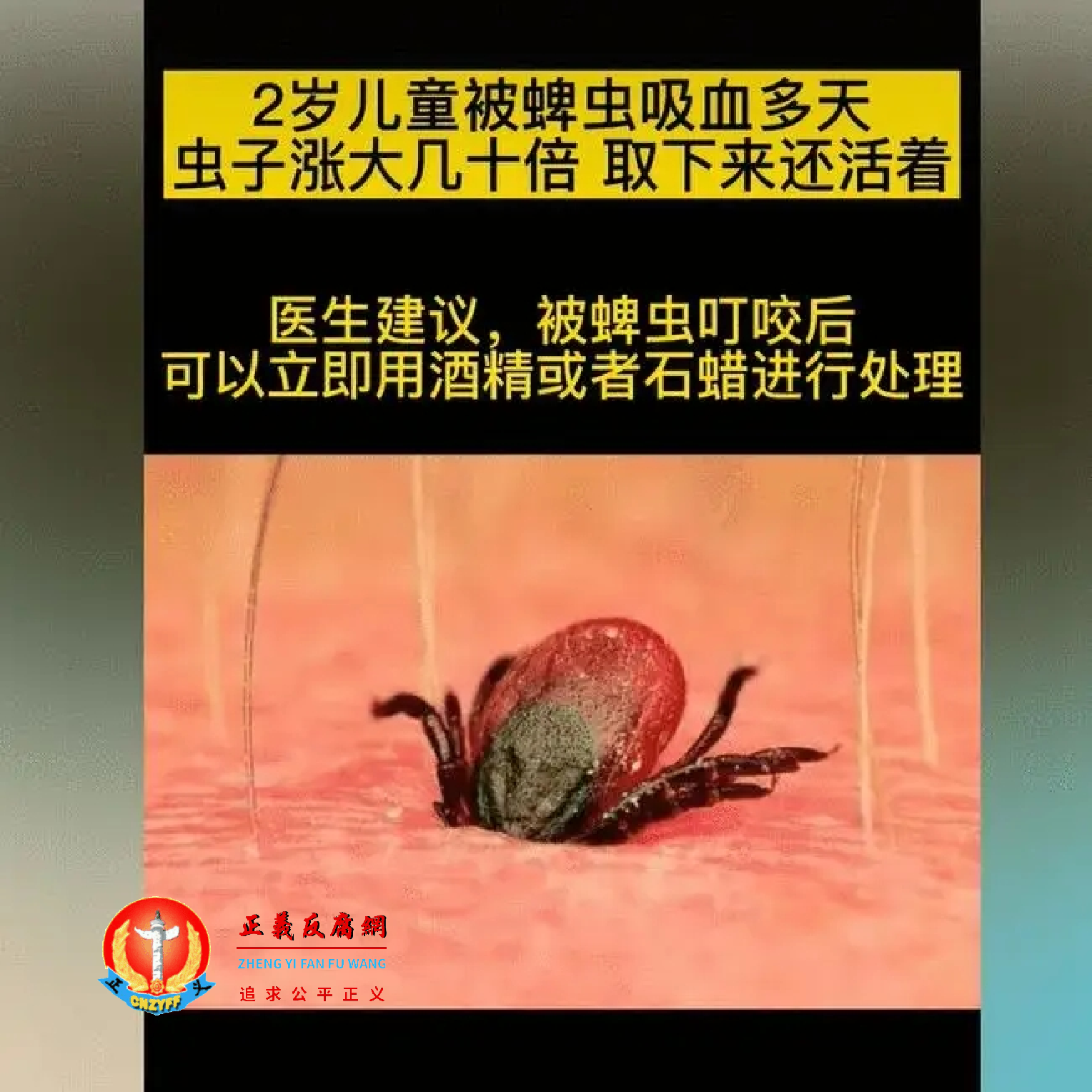 医生建议,被蜱虫叮咬后可以立即用酒精或者石蜡进行处理。蜱虫示意图。.png 医生建议,被蜱虫叮咬后可以立即用酒精或者石蜡进行处理。蜱虫示意图。.png